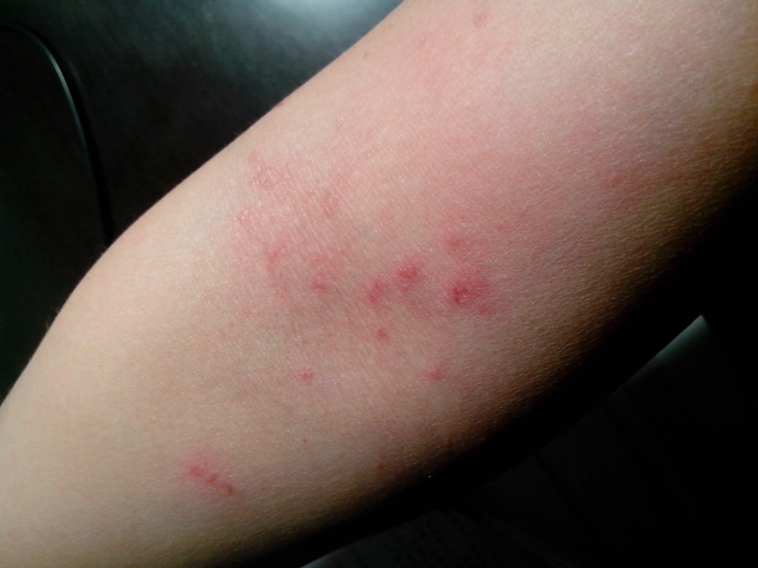 我一到夏天胳膊关节处就长疙瘩怎么办